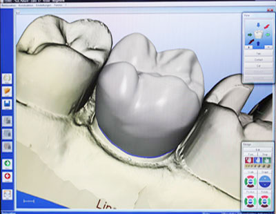 Cerec-Kronen